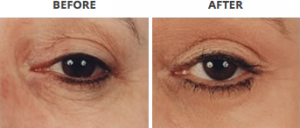 Eyelid Lift before and after