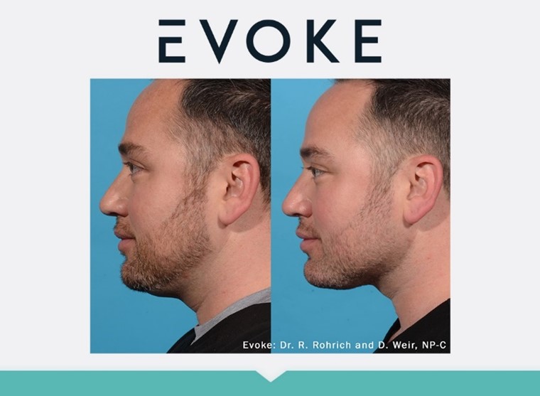 Evoke Before and After